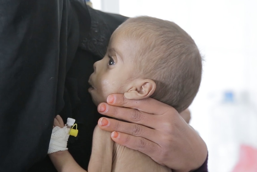 Baby in a feeding clinic in Yemen