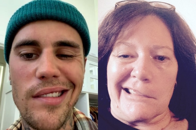 Justin Bieber and Elizabeth Robinson smile to demonstrate their facial paralysis caused by Ramsay Hunt syndrome.