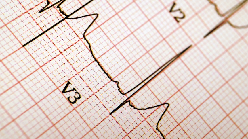 View of ECG output printout of a heart rate or pulse wave measurement equipment