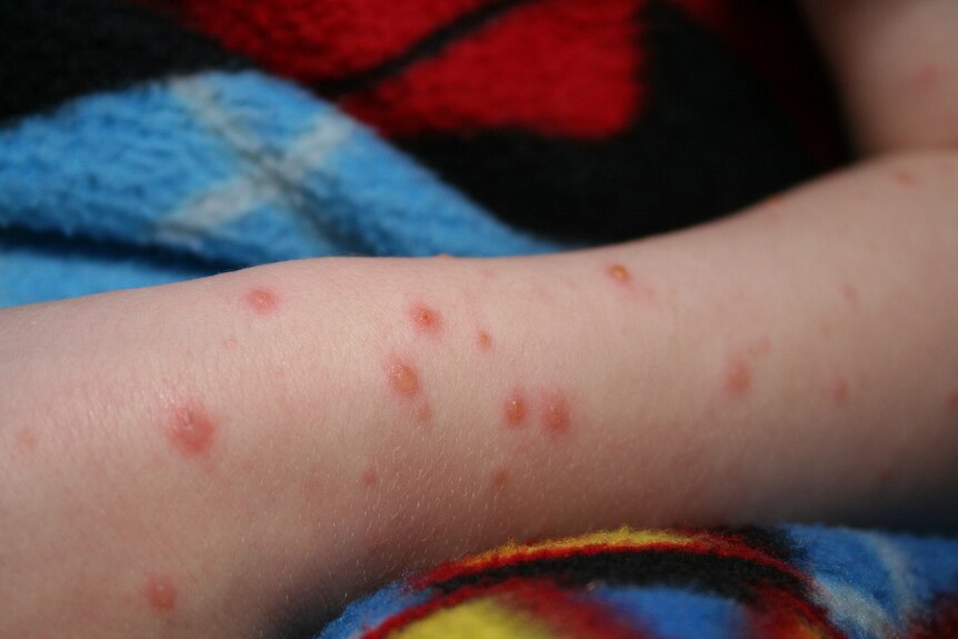 A child's leg with chickenpox. 