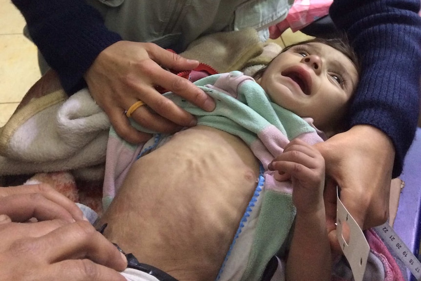 Starving infant in Madaya