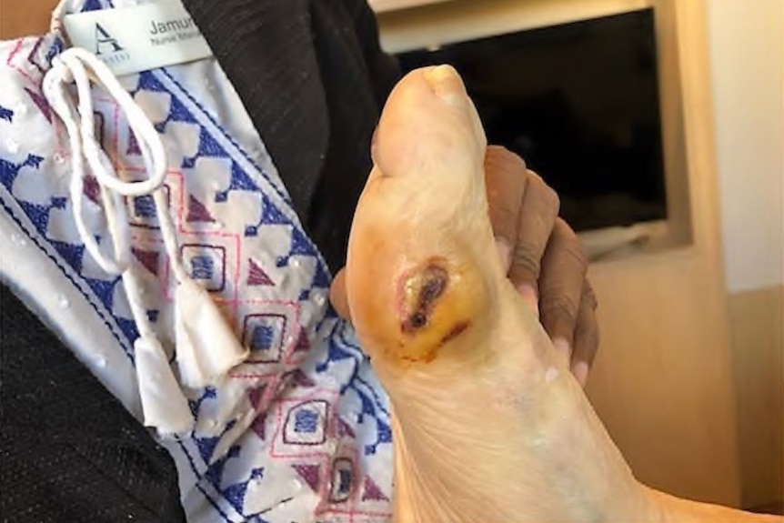 A foot with an open sore.