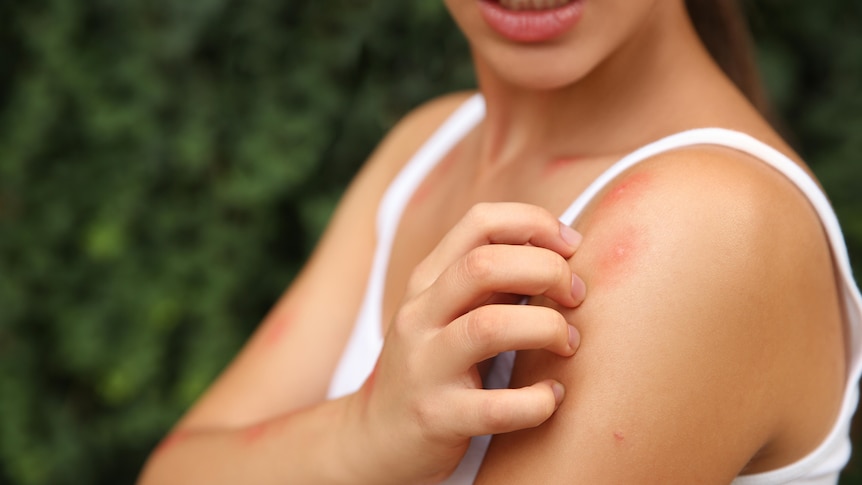 A woman touches multiple mosquito bites on her shoulder, learns how to manage them in her home and yard.
