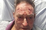 A man in a hospital bed with cuts and grazes on his forehead