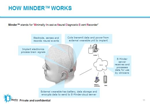 'Fit bit for the brain' that tracks epileptic seizures potential game ...
