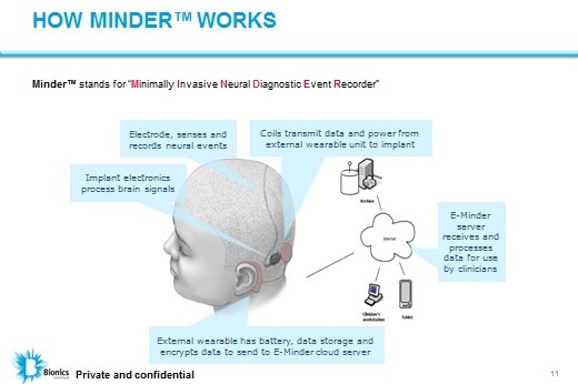 A photo of the workings of the E-Minder which is fitted under the scalp to records the brainwaves of people with epilepsy.