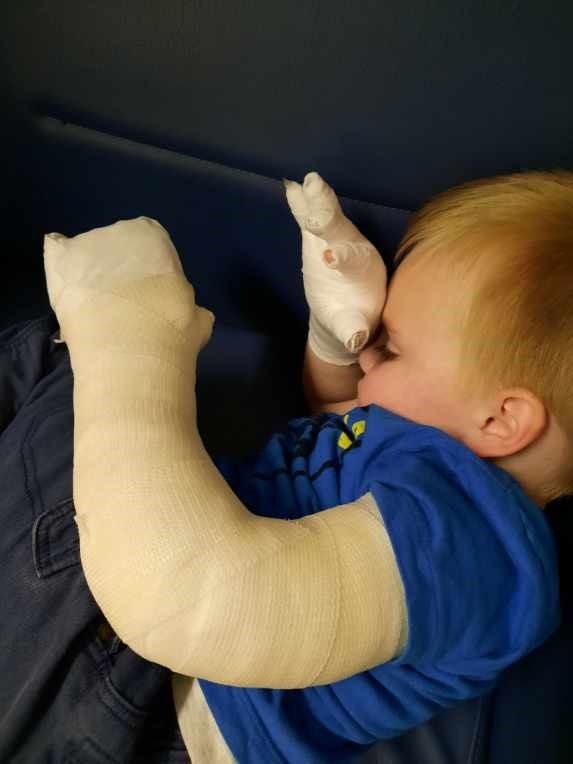 A young boy sleeps with his arm in a cast. 