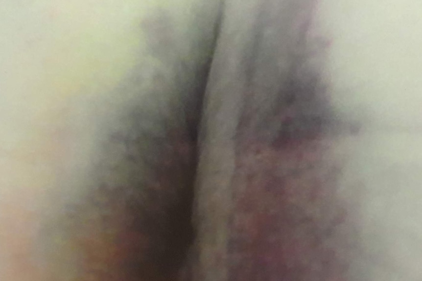 Terrible bruising evident on a woman's buttocks