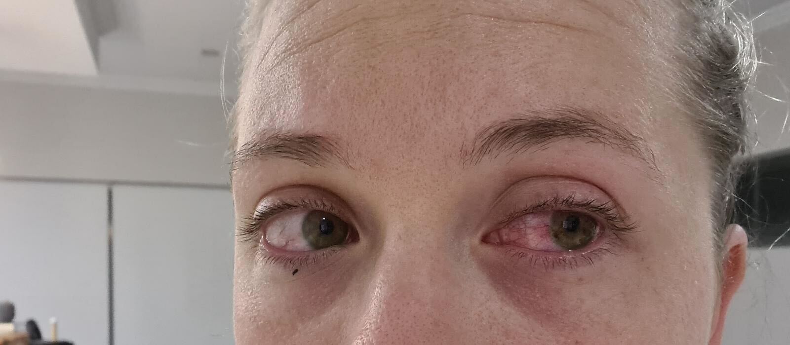 Primer plano del rostro de una mujer con el ojo inyectado en sangre. 