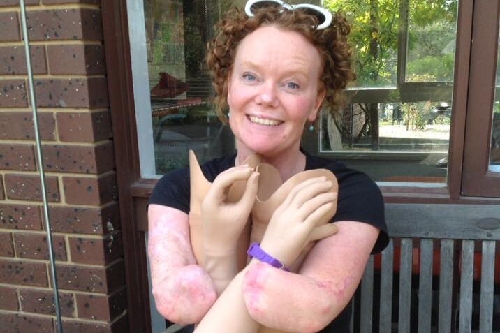 I have prosthetic hands and it constantly surprises people - ABC Everyday