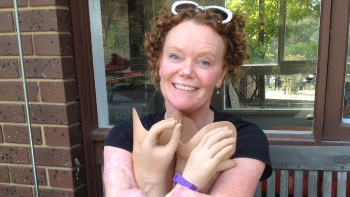 Mandy McCracken with her prosthetic hands. 