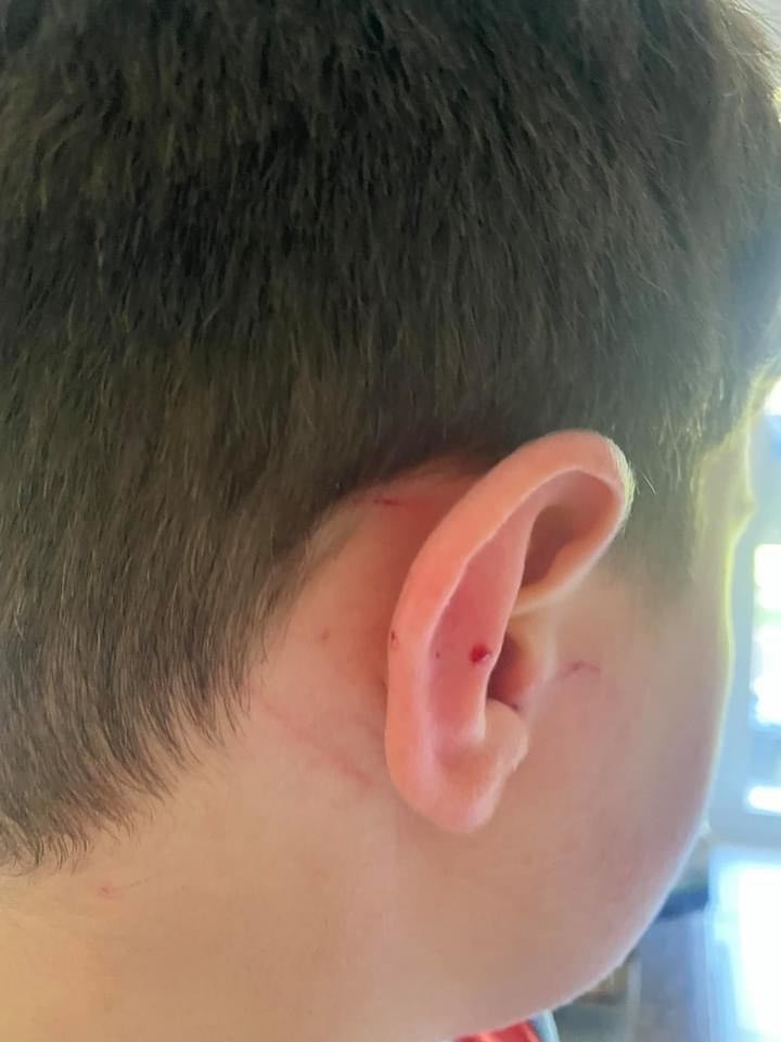 The right ear of a young boy with several scratch injuries.