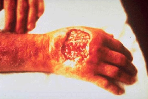 Secondary infection following red fire ant stings. Photo by Texas Department of Agriculture. (1)