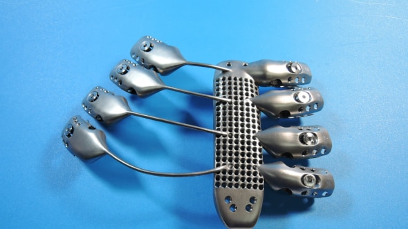 3D printed titanium ribcage and sternum