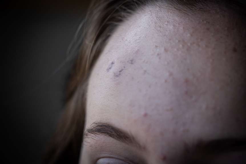 A close-up shot of an injury on a girl's forehead.