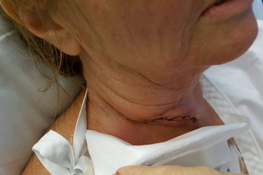 A close-up of the scar on Belinda Bingham's neck.