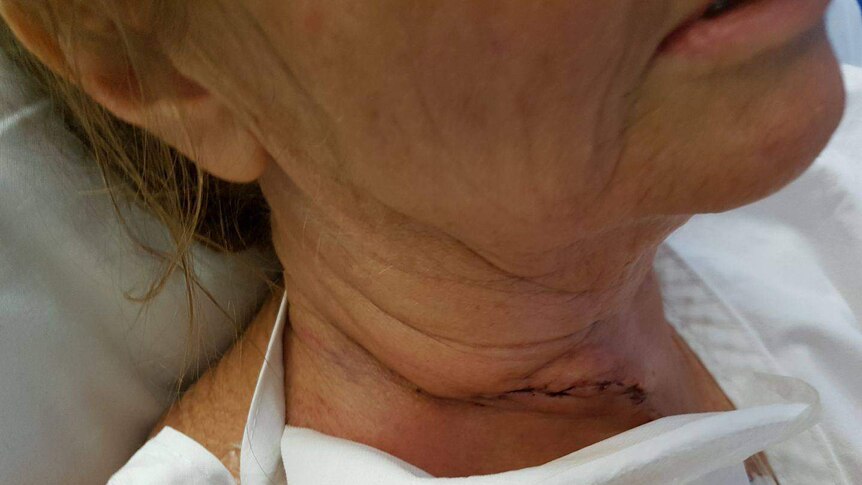 A close-up of the scar on Belinda Bingham's neck.
