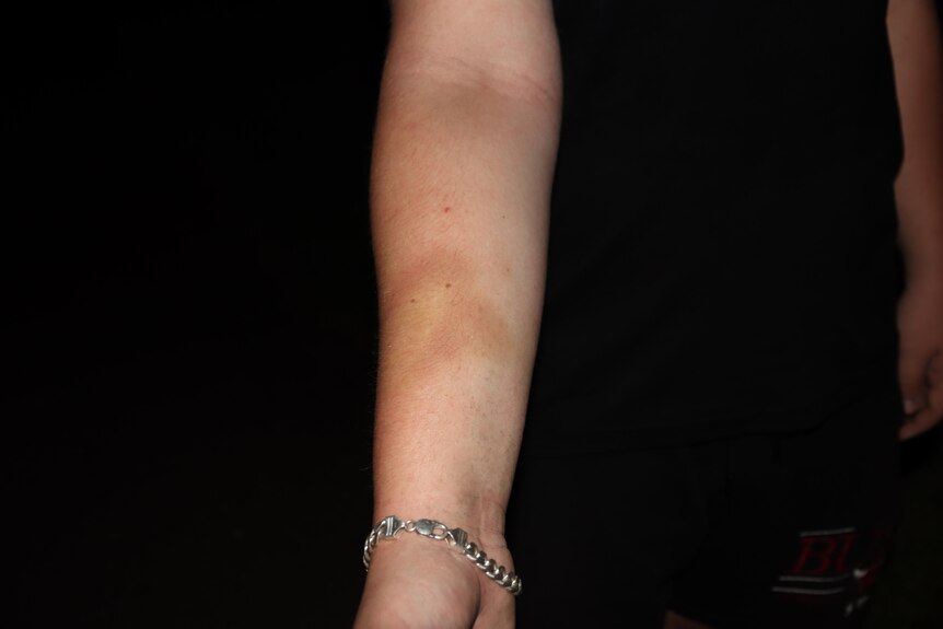 A bruise on someone's arm.