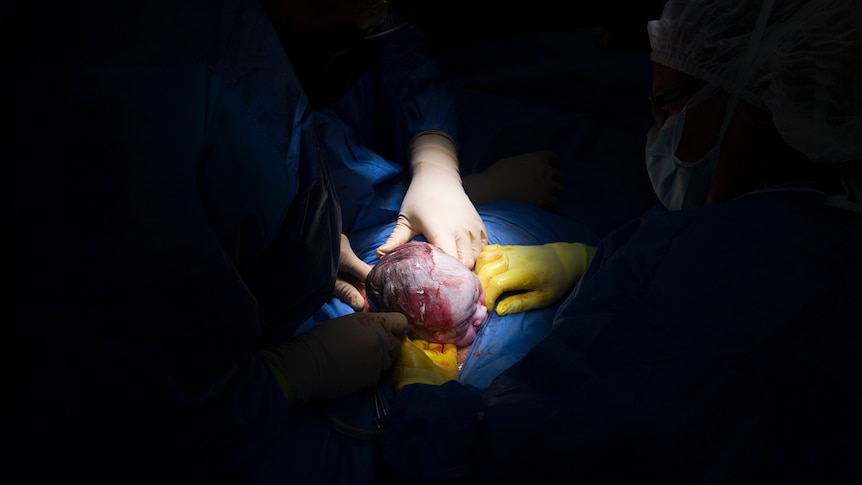 Baby born via caesarean section