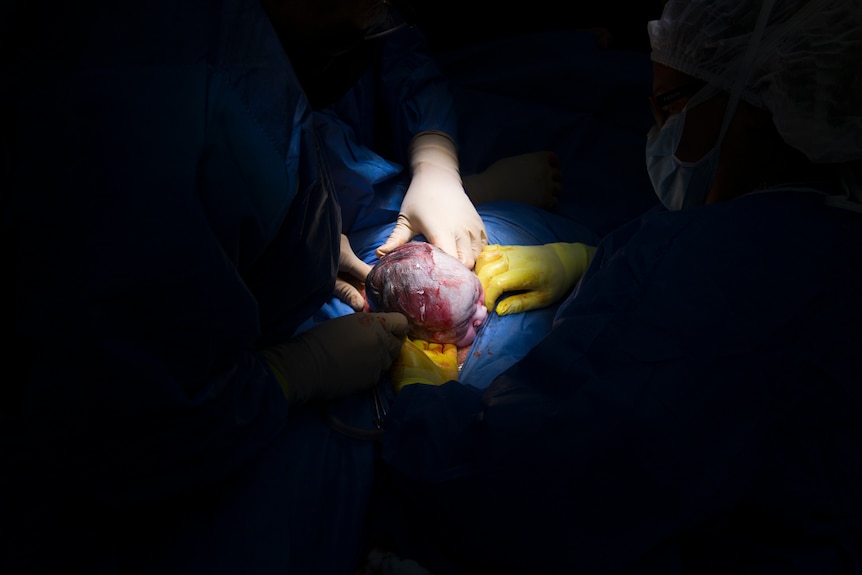 Baby born via caesarean section