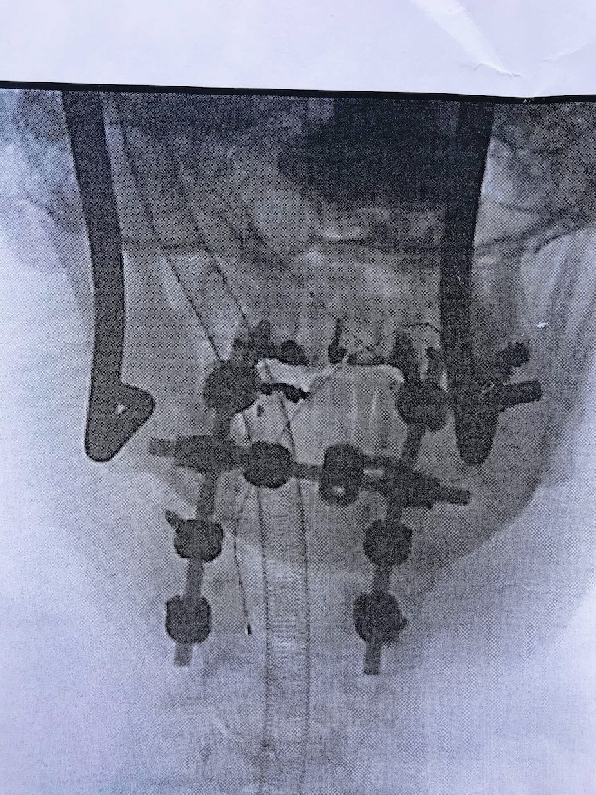 Colin Barker's X-ray