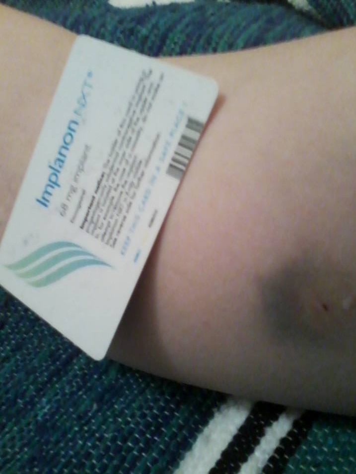 Spotlight on Implanon and Mirena long-acting reversible contraceptives, as women report severe side-effects - ABC News Spotlight on Implanon and Mirena long-acting reversible contraceptives, as women report severe side-effects - ABC News