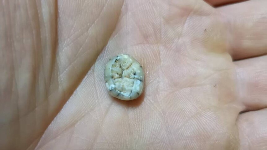 A tooth in a person's palm
