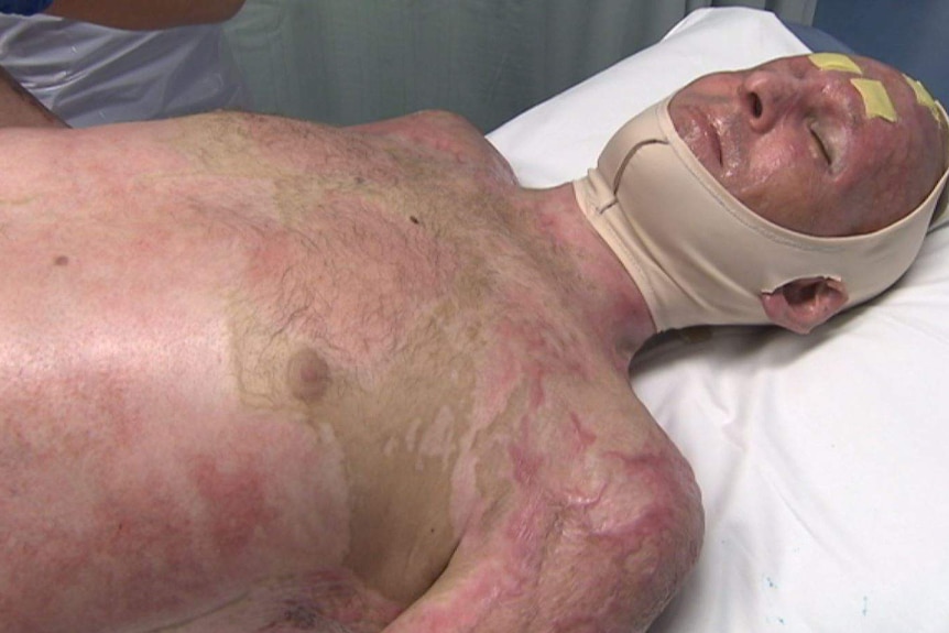 Matt Golinski suffered burns to 40 per cent of his body