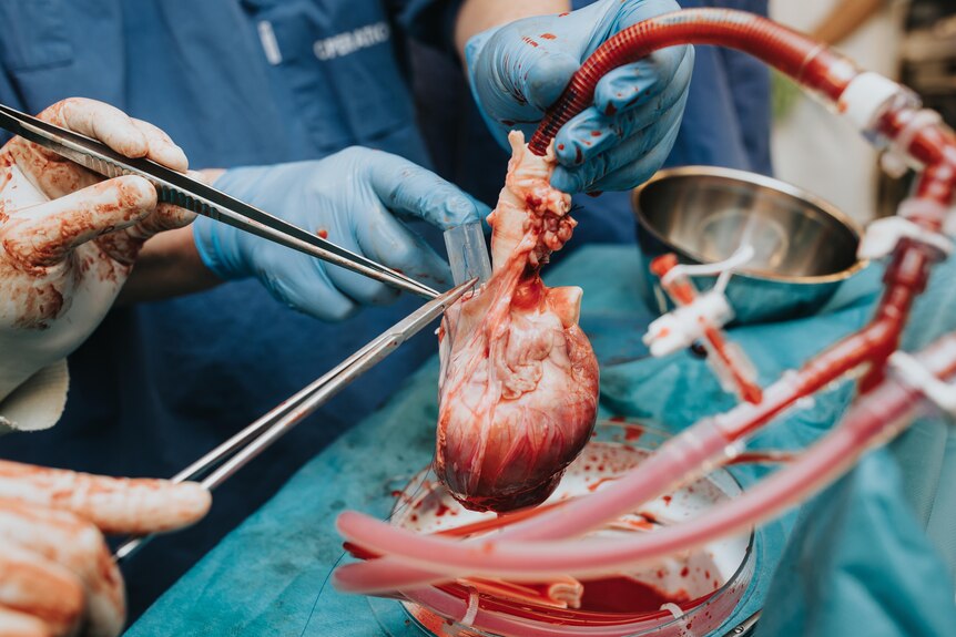 Human heart has tubes flowing into it, blue-gloved hands holds two tubes, while white-gloved hands hold two long tweezers.