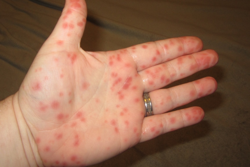 Tomato flu. A photo of hand foot mouth disease
