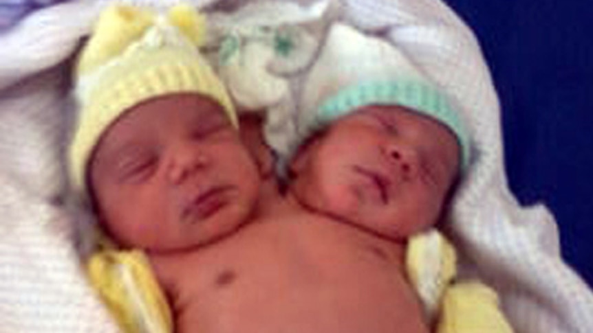 Conjoined twins born in Brazil