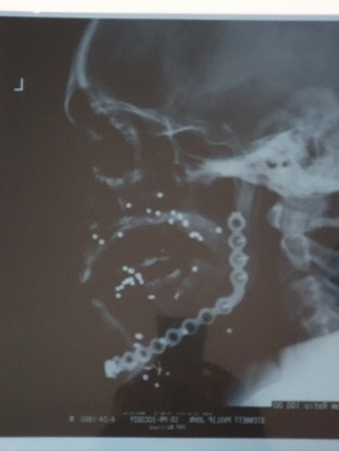 Black-and-white xray showing shrapnel in a victim's face