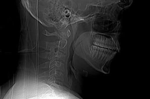 An x ray of James Pedemont's neck