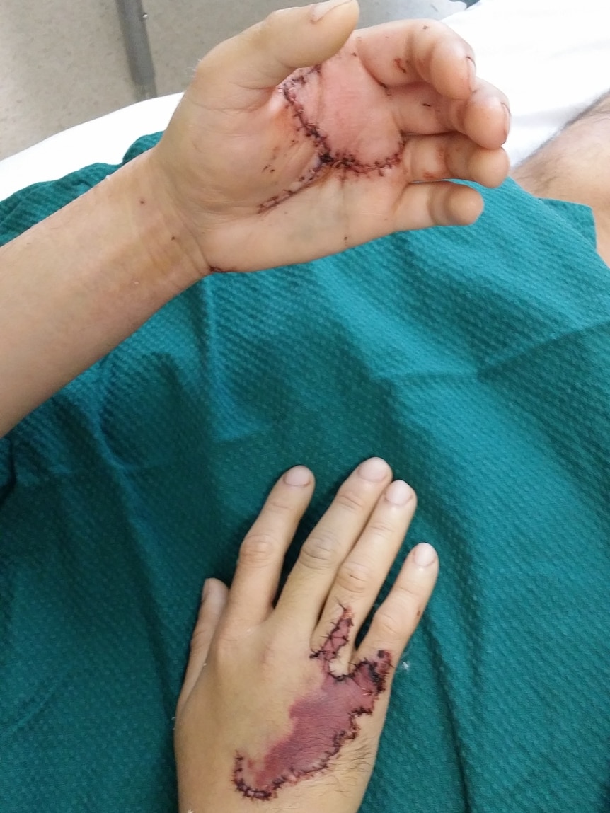 Dr Michael Wong's injured hands.