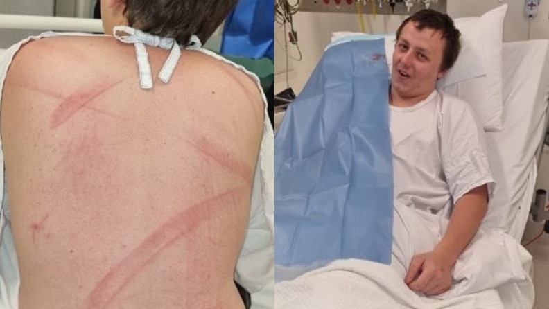 A young man in a hospital bed with marks on his back.