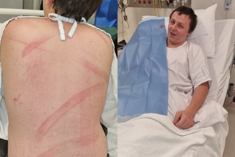 A young man in a hospital bed with marks on his back.