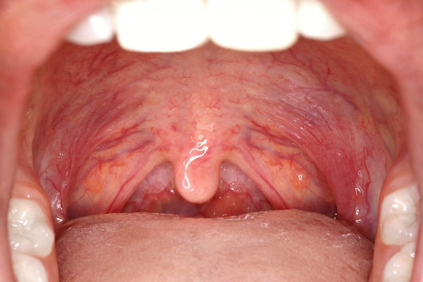 Looking inside someone's mouth at the tongue, palate and uvula