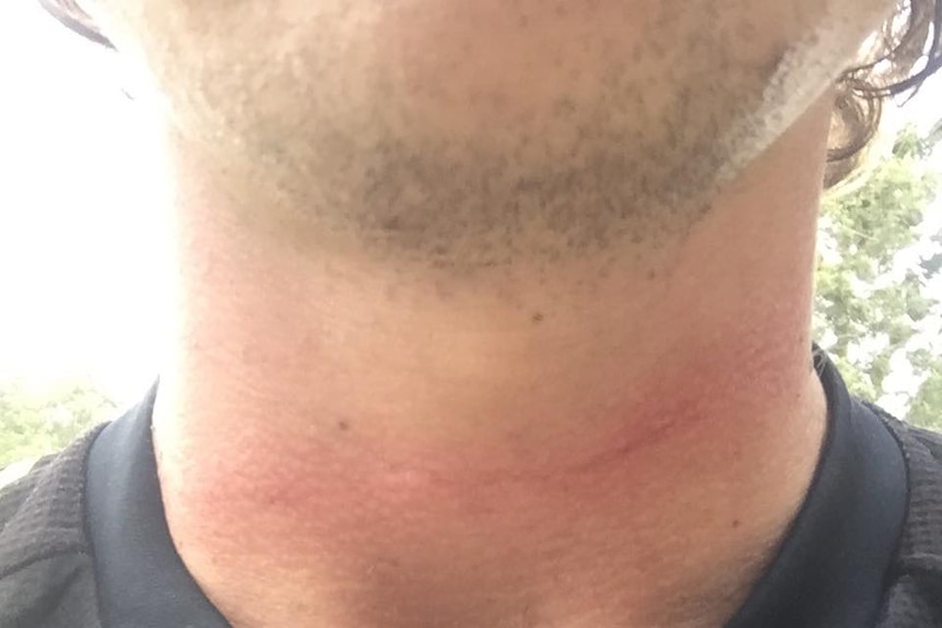 A man's neck with a red line across it
