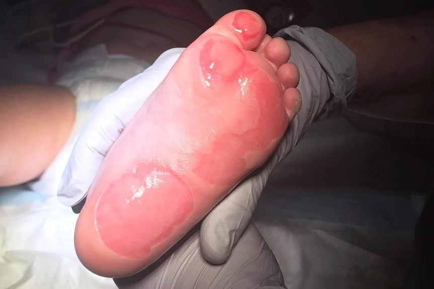 Doctors treat burns to the little girl's feet