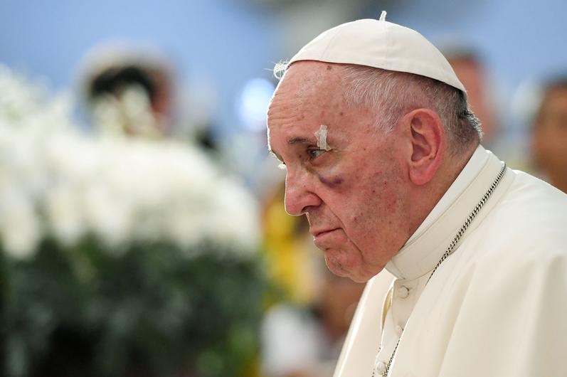 Pope Francis with a bruise under his eye and small bandage over this brow