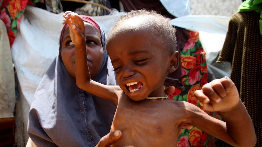 Girl holds malnourished Somali child