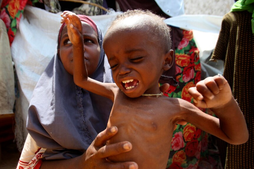 Girl holds malnourished Somali child