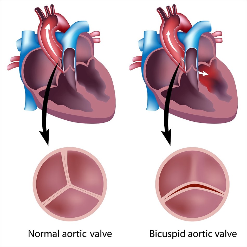 A medical diagram of a bicuspid aortic valve