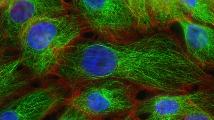 A microscope image showing breast cancer cells, which appear as messes of green string with a blue blob centre
