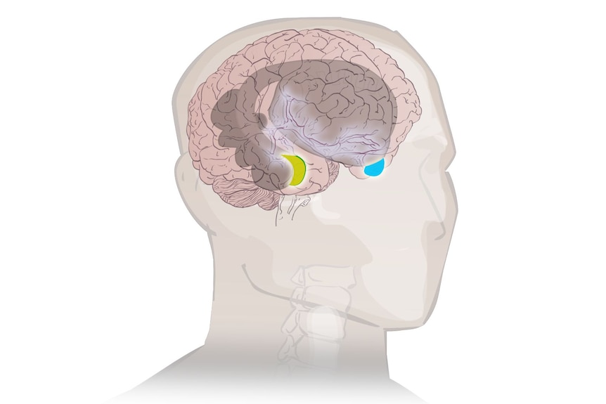 An illustration of the brain shows the amygdala highlighted in yellow and the hypothalamus in blue.