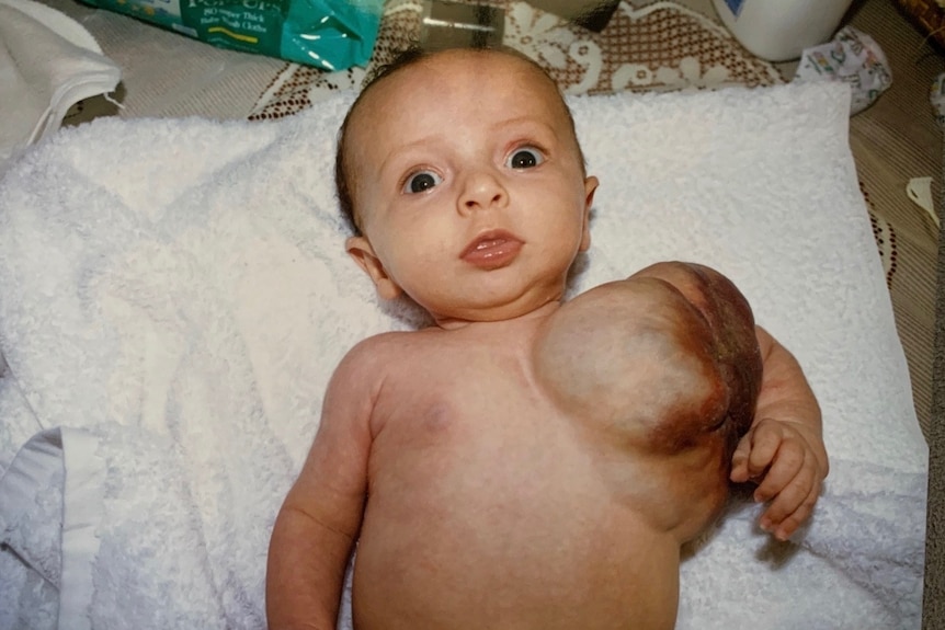 Caitlin Rutherford-Heard as a baby laying on her back with rare vascular malformation on her chest.
