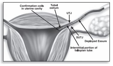 A black-and-white diagram from a brochure showing the insertion of a coil inside a fallopian tube.