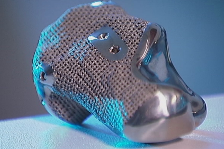 An exact titanium replica of Len Chandler's heel was made using a 3D printer.