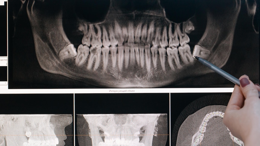 An X-ray of a mouth with teeth visible. A pen points towards the image. 