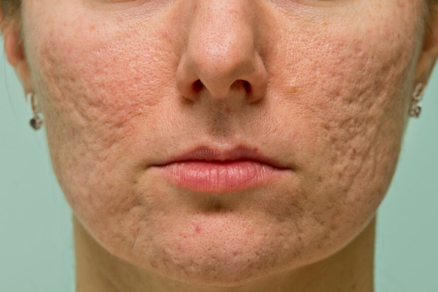 Facial scarring from acne
